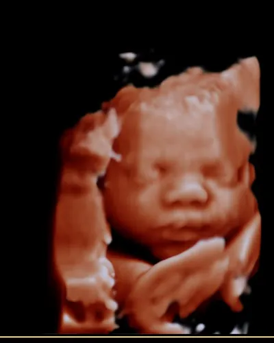 3D ultrasound face image example with clear angle