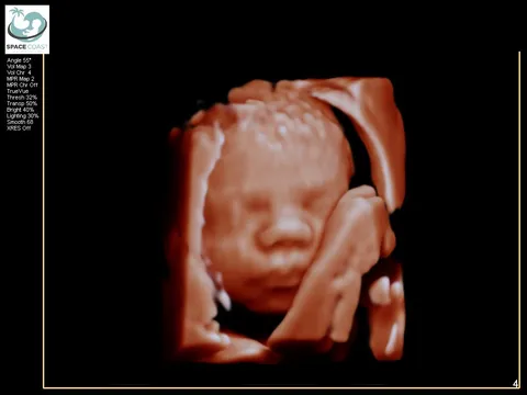 4D ultrasound profile view example