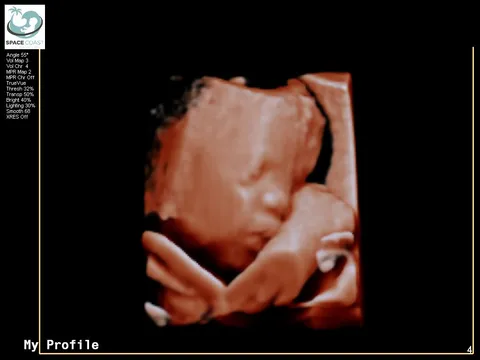 3D ultrasound face-forward example